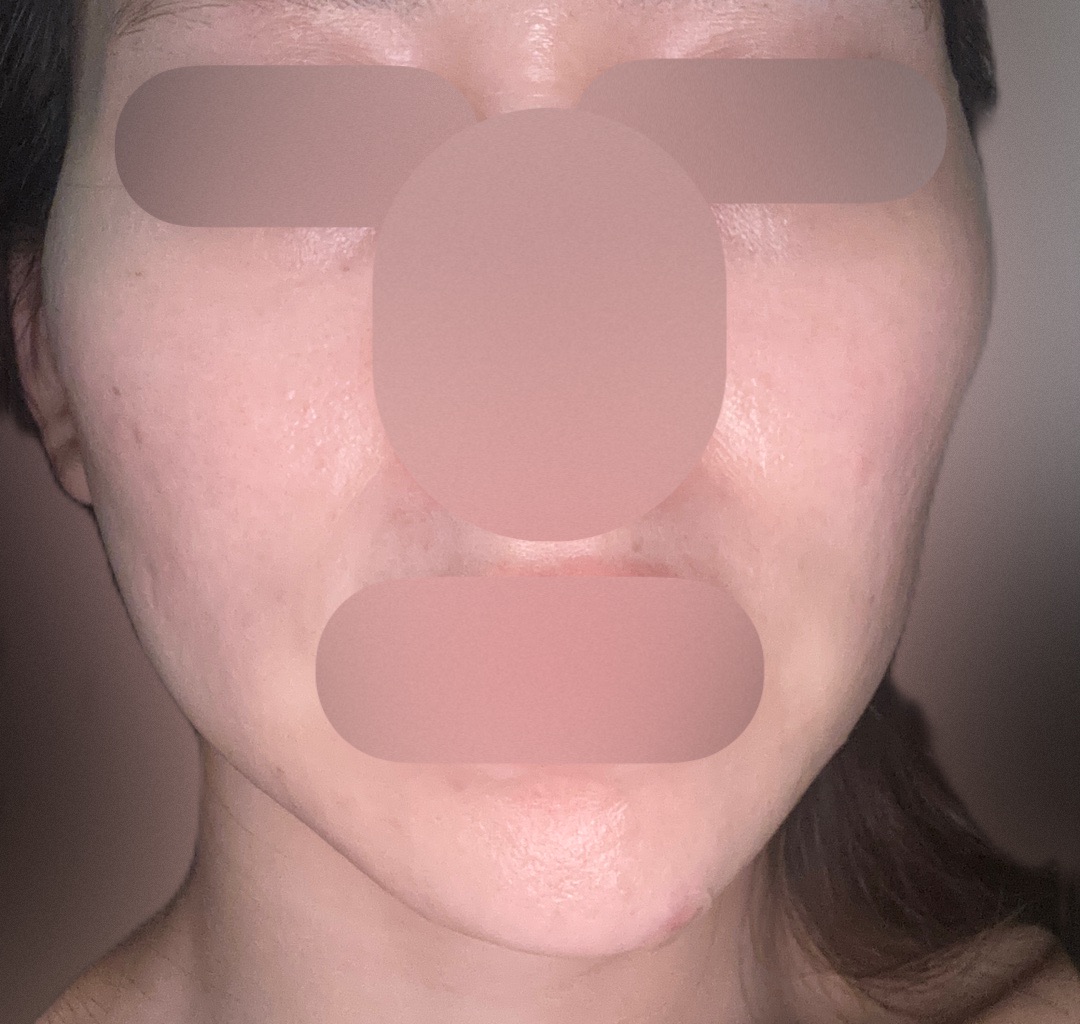 エレクトロポレーション 美肌への近道！】湘南美容クリニックのエレクトロポレーション