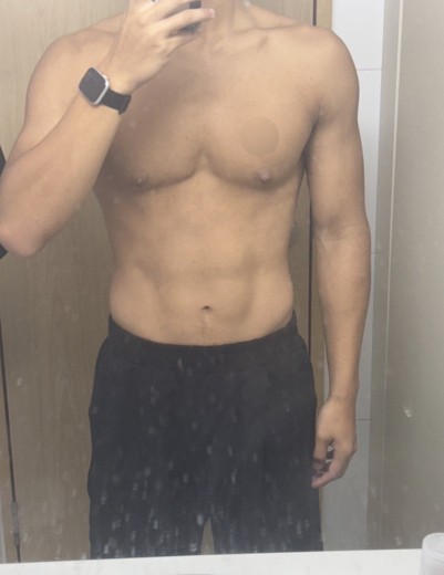 before photo: 여유증수술