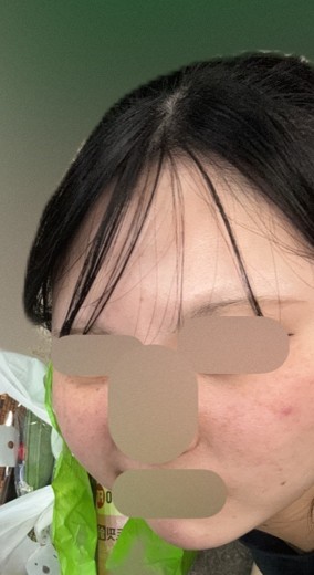 after photo: ピコトーニング
