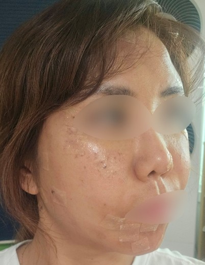 after photo: 점제거시술, V레이저