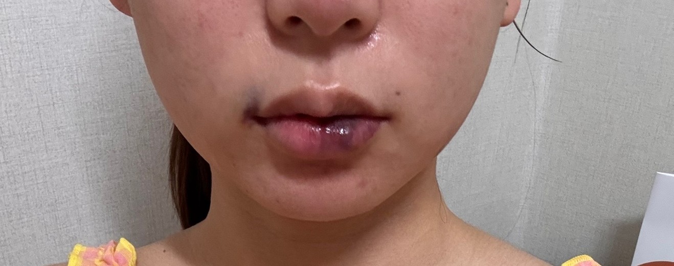 after photo: 입꼬리필러, 입술필러