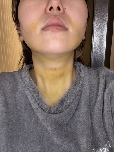 after photo: 糸リフト, 脂肪吸引(顎下), 脂肪吸引(顔), 脂肪吸引(頬)