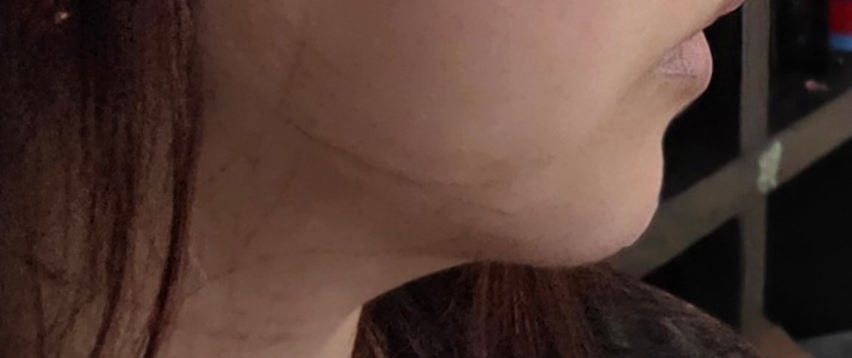 after photo: 입술필러