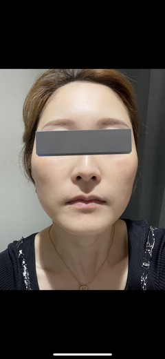 after photo: ララピール(LHAピーリング)
