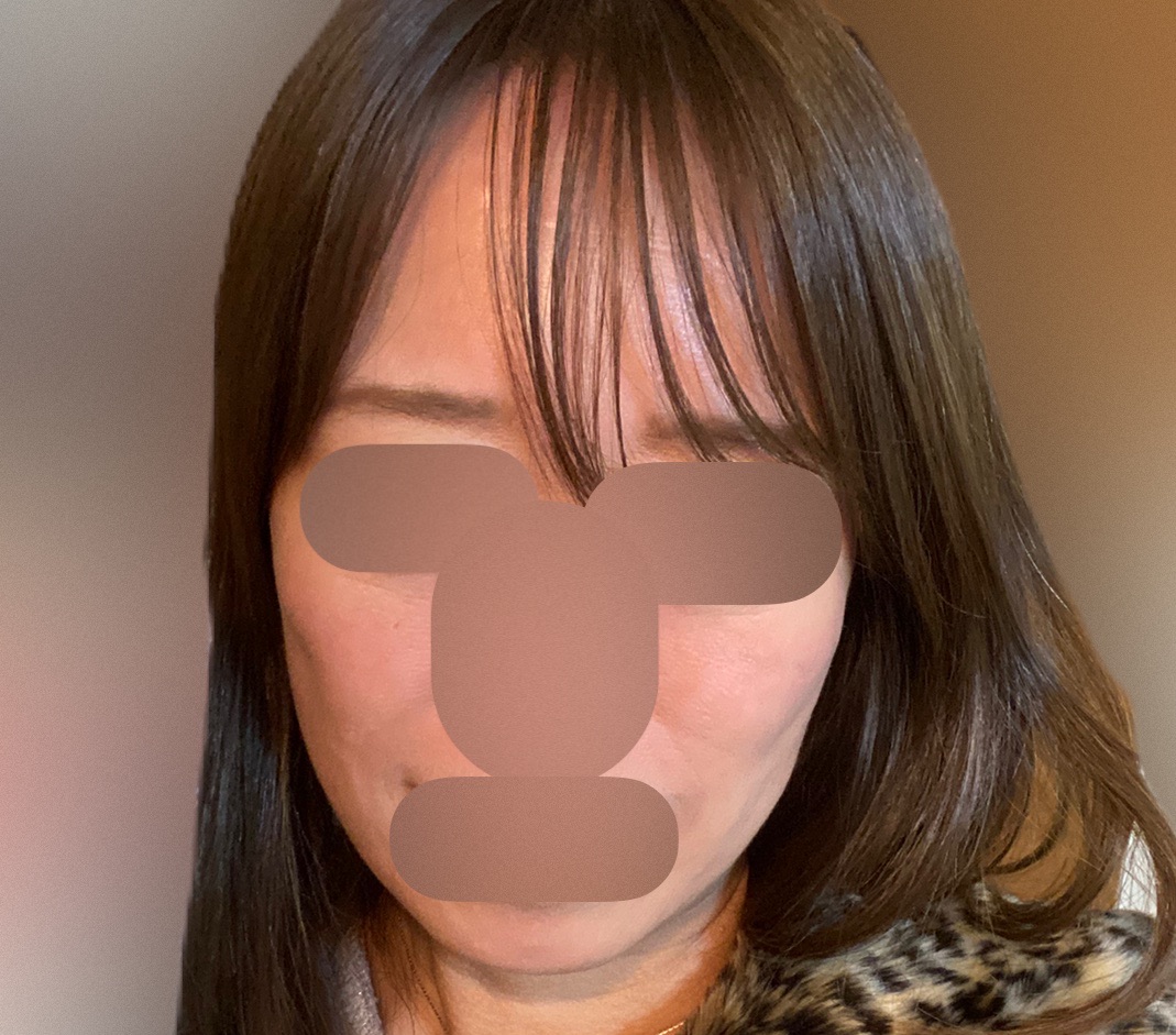 HIFU全顔650shot ウルトラフォーマーMPT【2月28日迄にご予約頂いた方