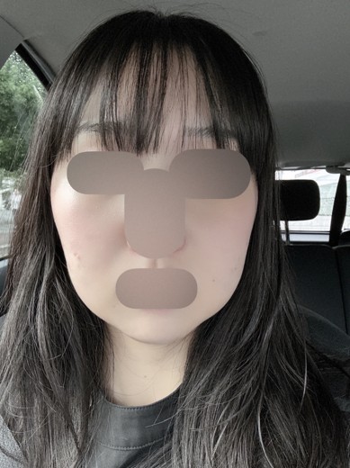 after photo: 脂肪溶解注射(顔)