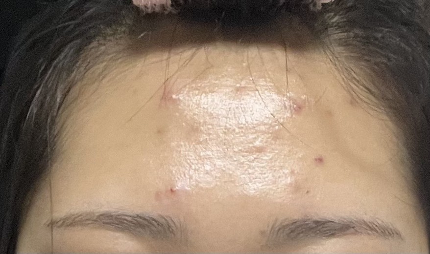 before photo: 이마필러