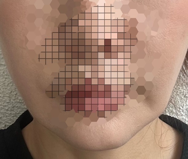before photo: 糸リフト