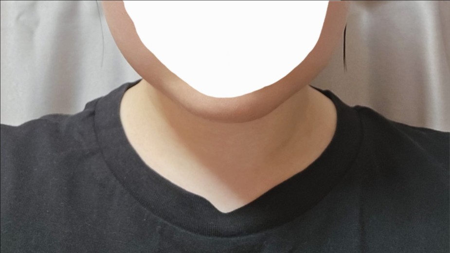 after photo: 脂肪溶解注射(顔)