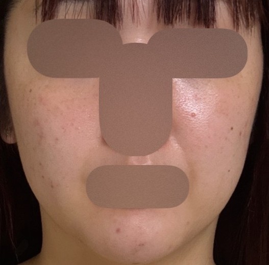 before photo: ルメッカ