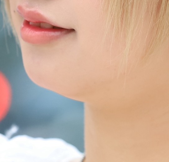 before photo: 脂肪溶解注射(顔)
