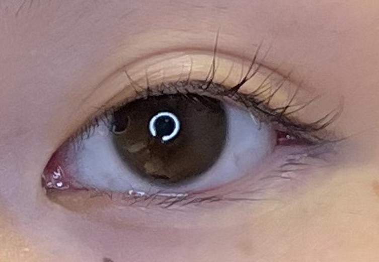 after photo: 目尻切開