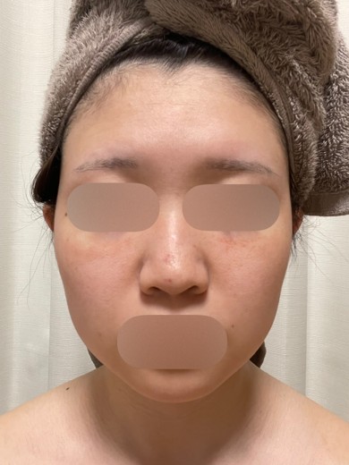 after photo: ダーマペン, エクソソーム