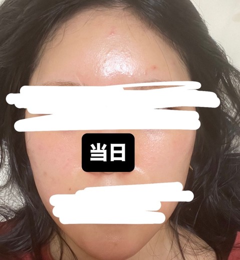 after photo: ピーリング, ルメッカ