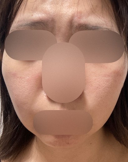 after photo: 糸リフト