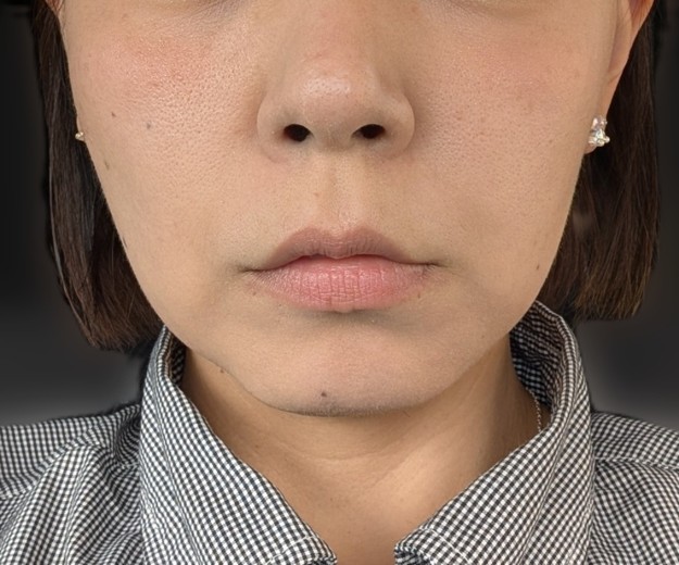after photo: ソノクイーン(ハイフ)
