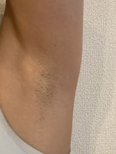after photo: 脱毛(ワキ)