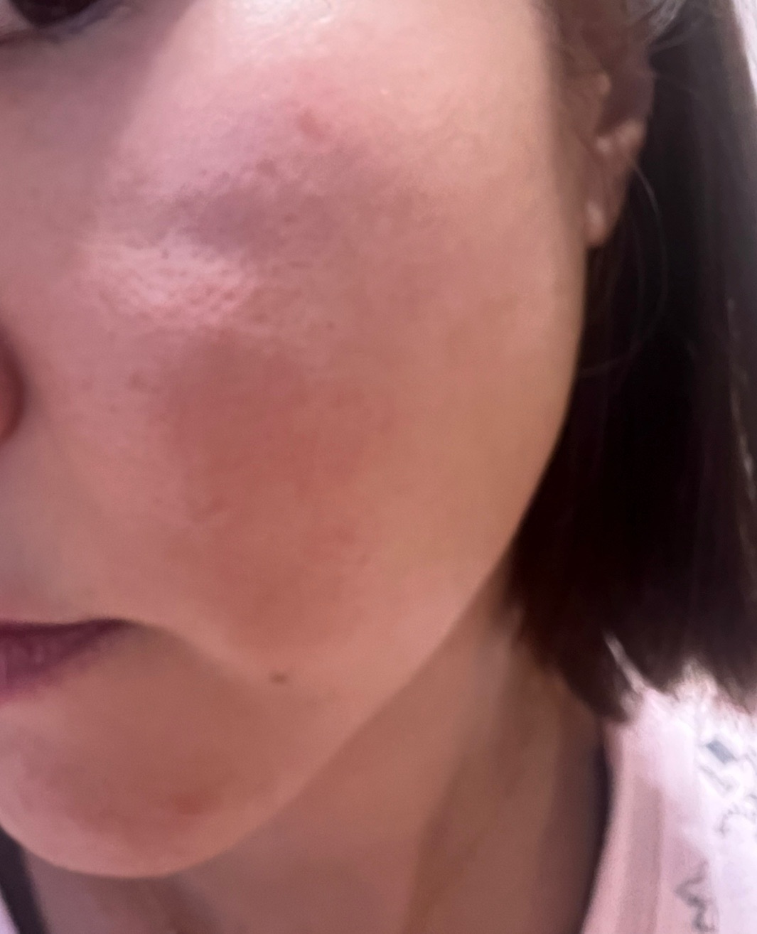 コラーゲンピールの施術・口コミ・クリニック情報(2026) | カンナムオンニ