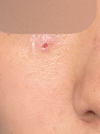 after photo: CO2レーザー, ほくろ除去(レーザー)
