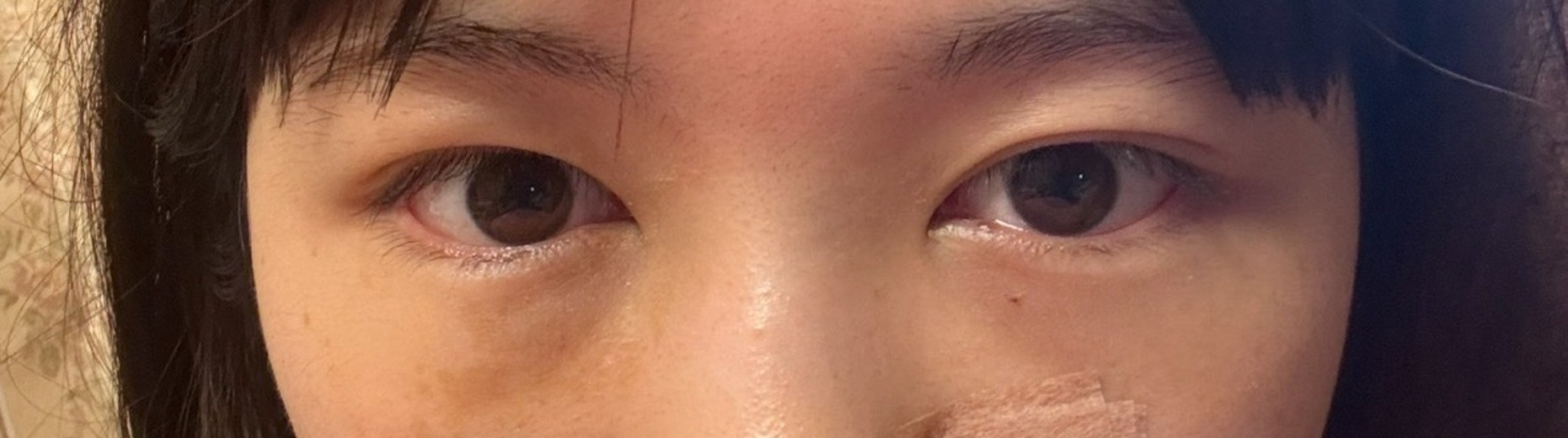 after photo: 目の下脂肪再配置(ハムラ・裏ハムラ法)