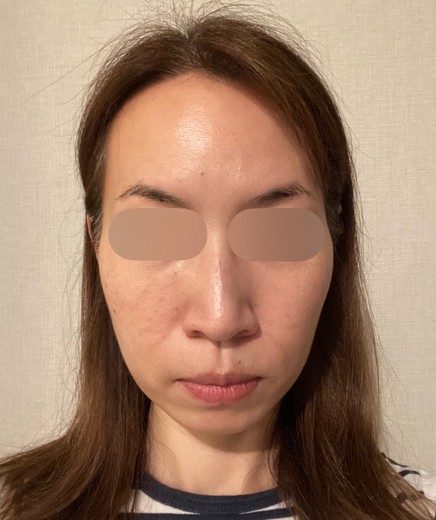 after photo: ピコトーニング