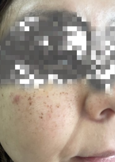 after photo: ピーリング, ルメッカ