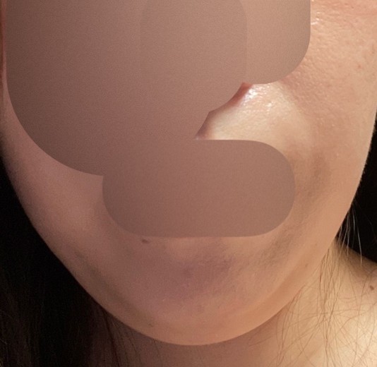 after photo: 脂肪溶解注射(顔)