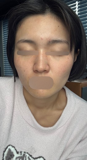 after photo: IPL(光/フォト治療), ピーリング, エレクトロポレーション