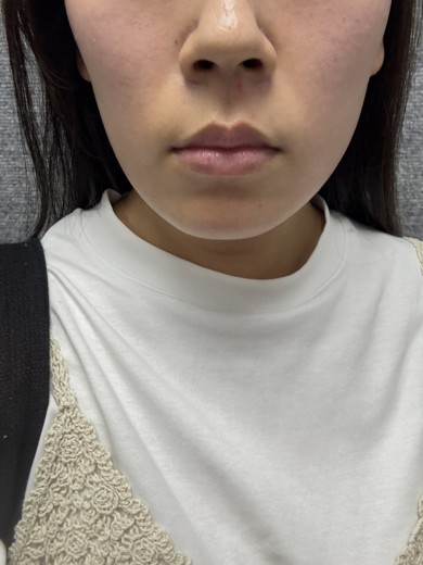 after photo: インモード