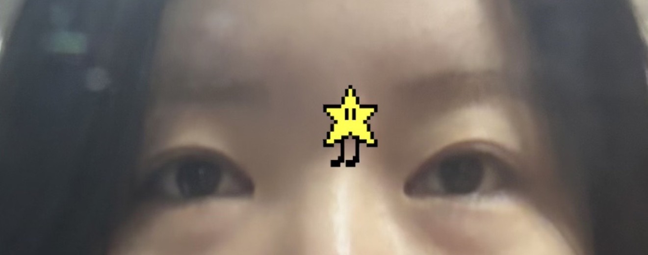 before photo: 눈밑지방이식, 눈밑지방재배치