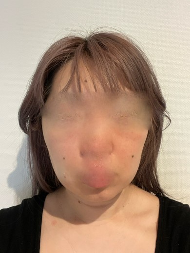 before photo: サーモン注射