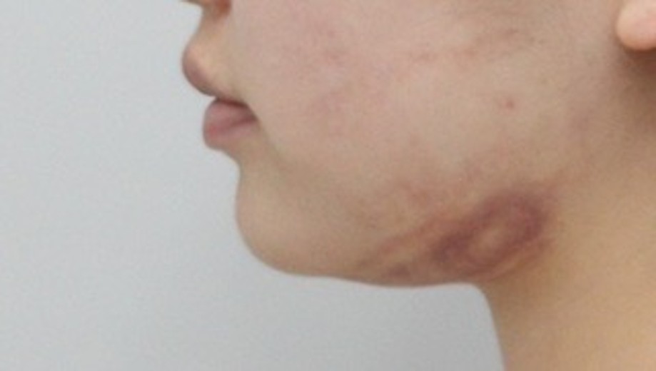 before photo: ふくらはぎボトックス, エラボトックス