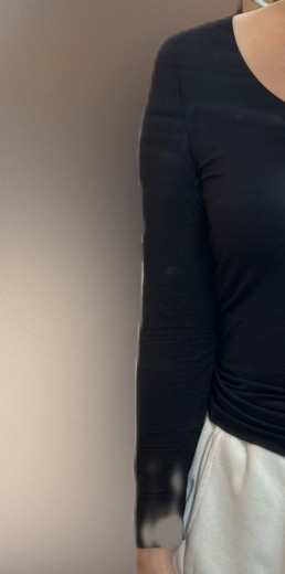 after photo: 팔지방분해주사