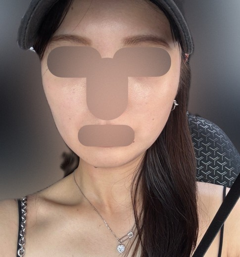 after photo: リニアファーム(ハイフ)