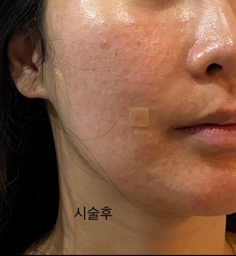 after photo: 리쥬란힐러