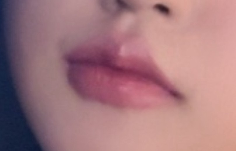 before photo: 입꼬리필러, 입꼬리보톡스, 입술필러