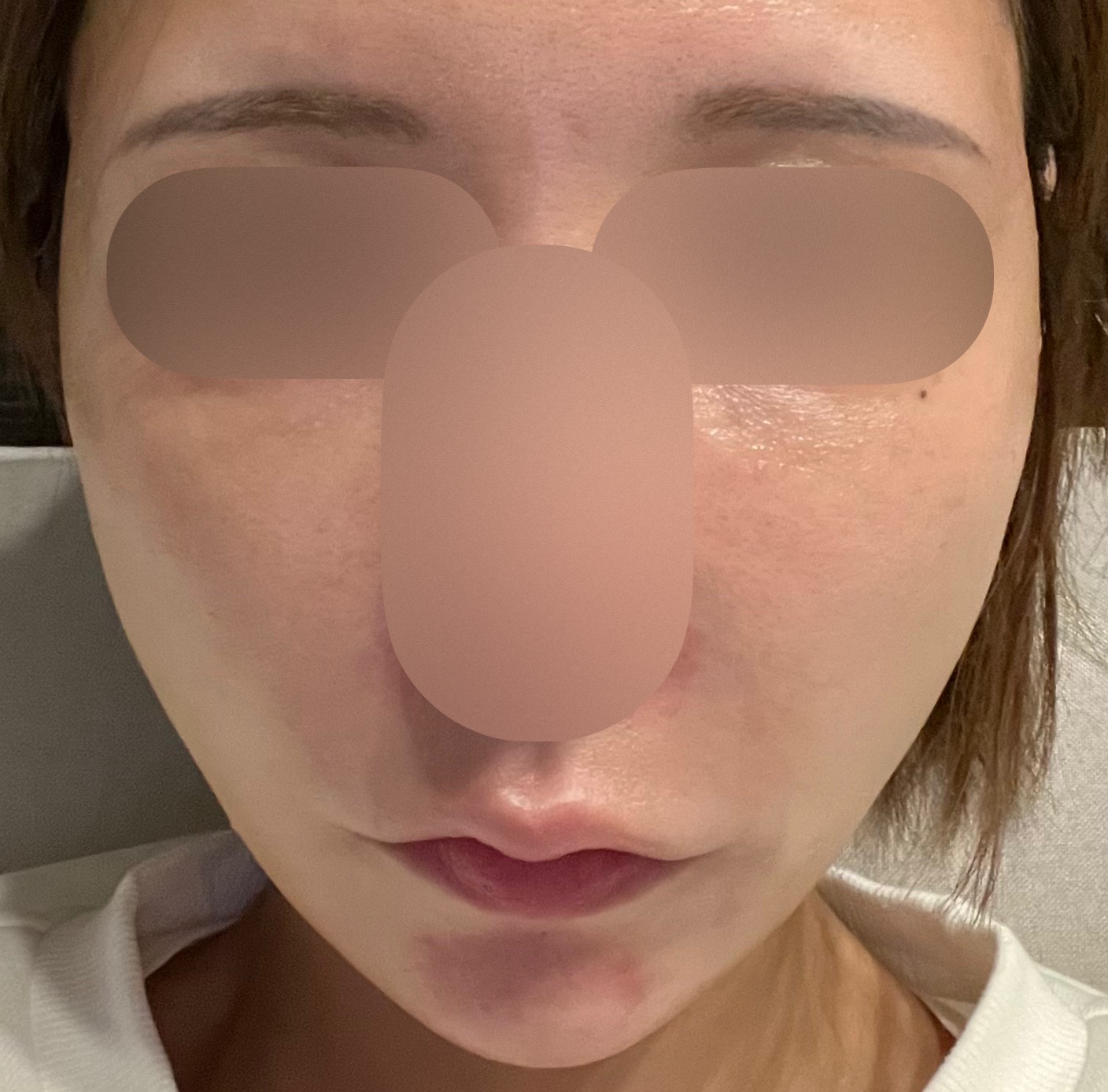 IPLフォトフェイシャル（全顔2周）＋エレクトロポレーション（薬剤1種