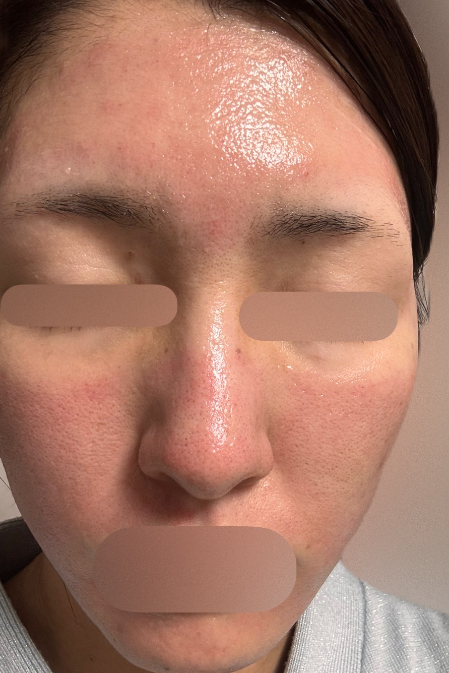 ダーマペン （全顔・首）｜表面麻酔込み | Wellness Plus Clinic