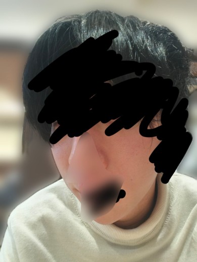after photo: ポテンツァ(POTENZA), 診断・検査, ジュベルック(Juvelook)