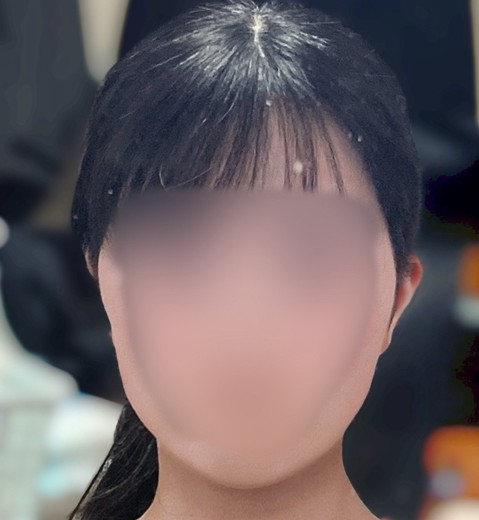 after photo: 脂肪溶解注射(顔)