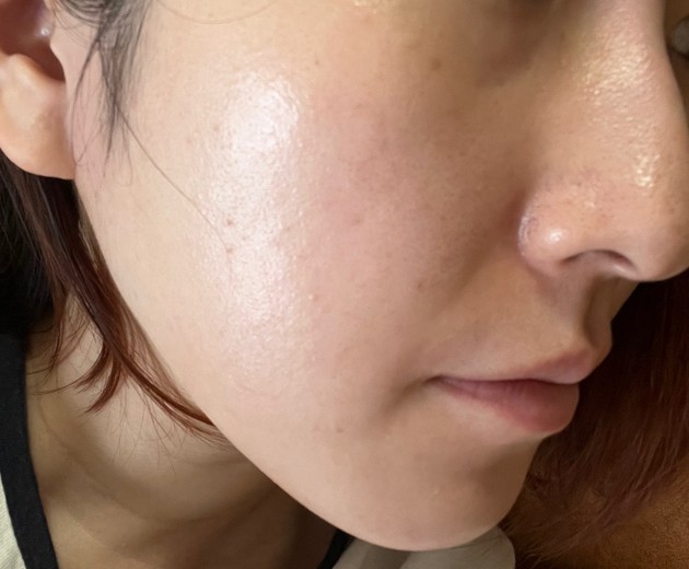 after photo: エレクトロポレーション, ルメッカ