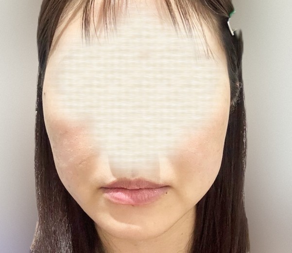 after photo: ボルニューマ