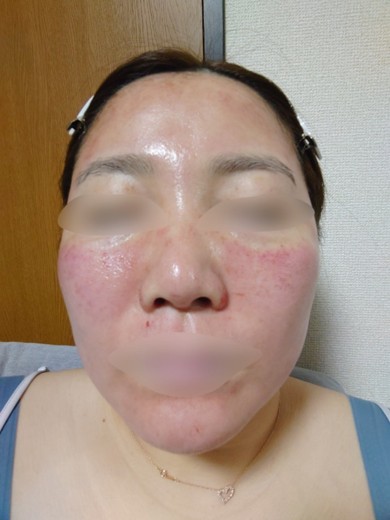 after photo: ダーマペン