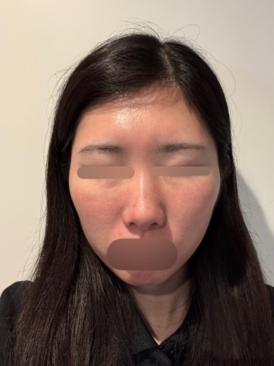 after photo: ヴェルベットスキン