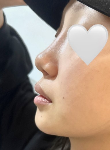 after photo: 비중격만곡증수술, 콧대(보형물), 코끝(자가연골), 비후성비염수술