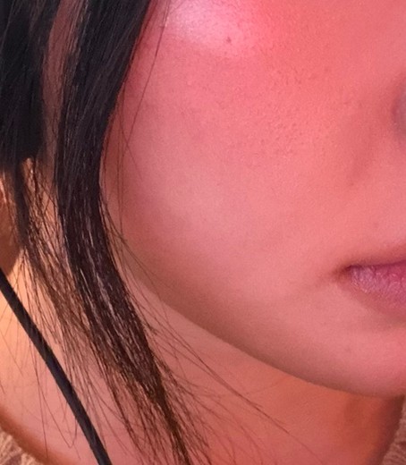 after photo: 인모드리프팅