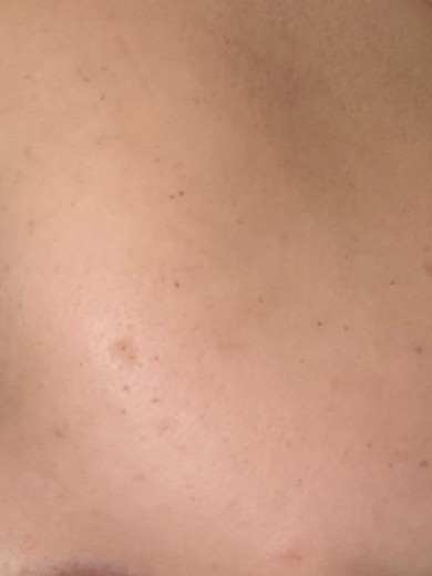 after photo: IPL(光/フォト治療), 診断・検査