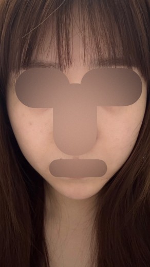 after photo: チタニウムリフト