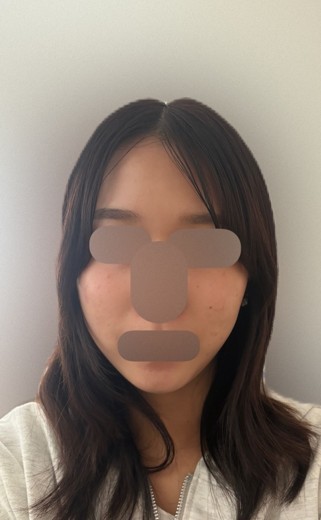 before photo: ヒーライト