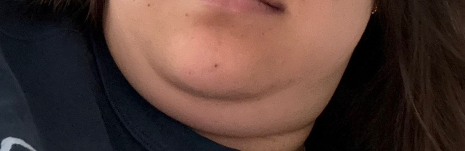 before photo: 이중턱지방흡입, 얼굴지방흡입, 이중턱근육묶기